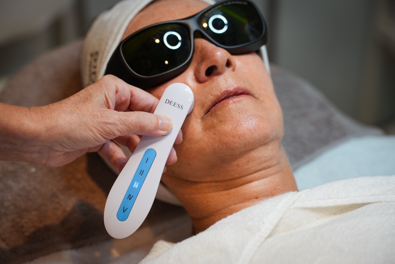 Laserontharing